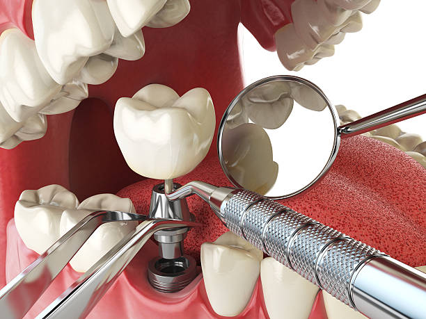 Best Emergency Root Canal Treatment in Manassas Park, VA